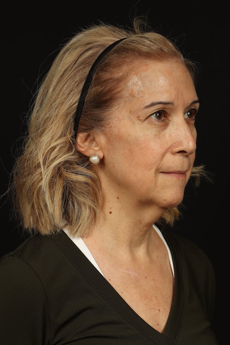 Facelift Before & After Gallery - Patient 439276 - Image 7
