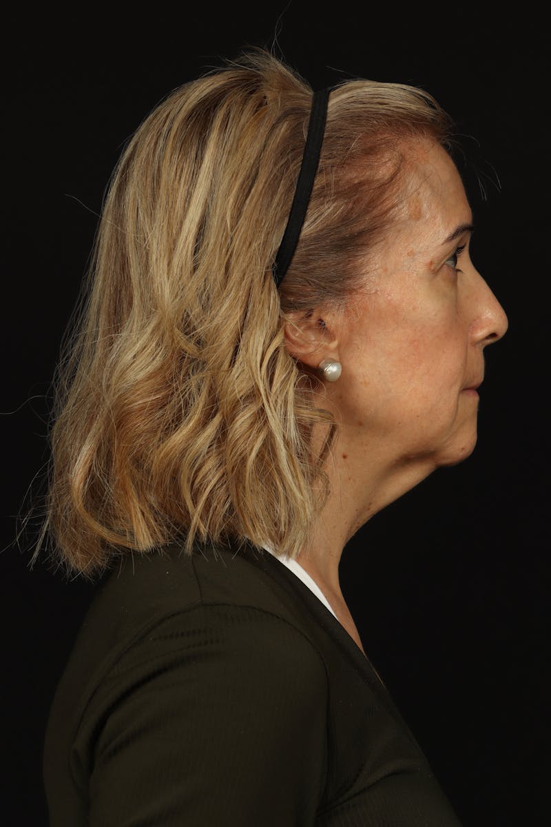 Facelift Before & After Gallery - Patient 439276 - Image 9