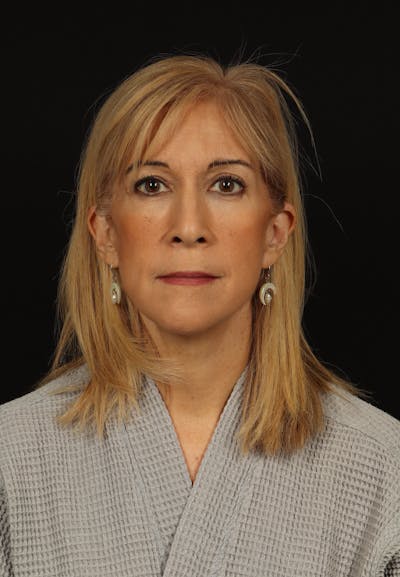 Facelift Before & After Gallery - Patient 439276 - Image 2