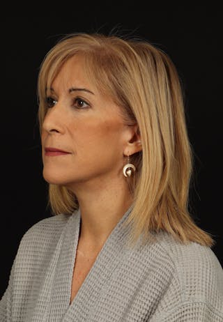 Facelift Before & After Gallery - Patient 439276 - Image 4