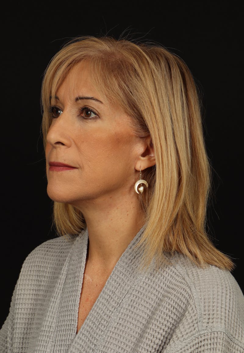 Facelift Before & After Gallery - Patient 439276 - Image 4