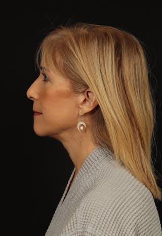 Facelift Before & After Gallery - Patient 439276 - Image 6