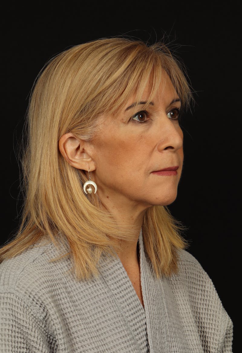 Facelift Before & After Gallery - Patient 439276 - Image 8