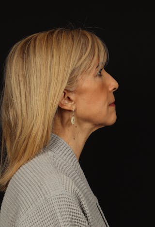 Facelift Before & After Gallery - Patient 439276 - Image 10