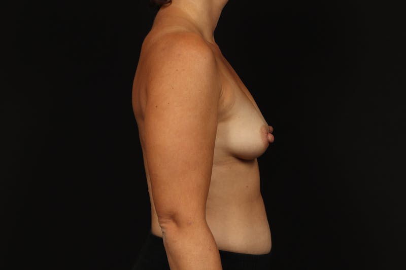 Breast Augmentation Silicone Gel Before & After Gallery - Patient 402001 - Image 9