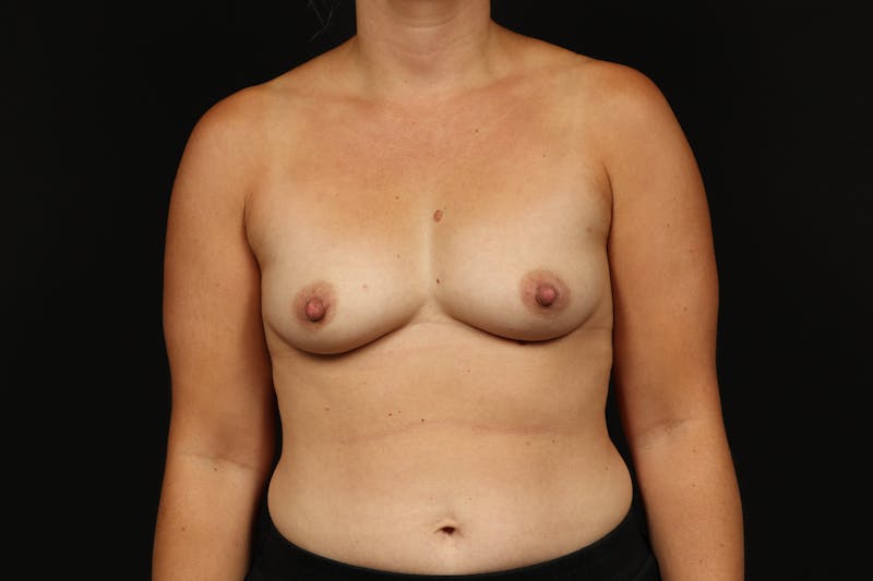 Breast Augmentation Silicone Gel Before & After Gallery - Patient 402001 - Image 1