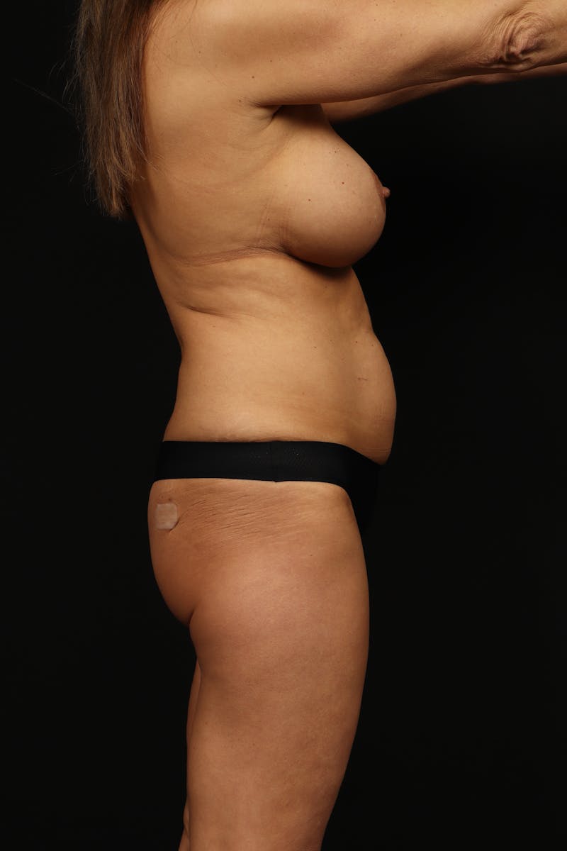 Aesthetic Breast Revision Before & After Gallery - Patient 472421 - Image 9