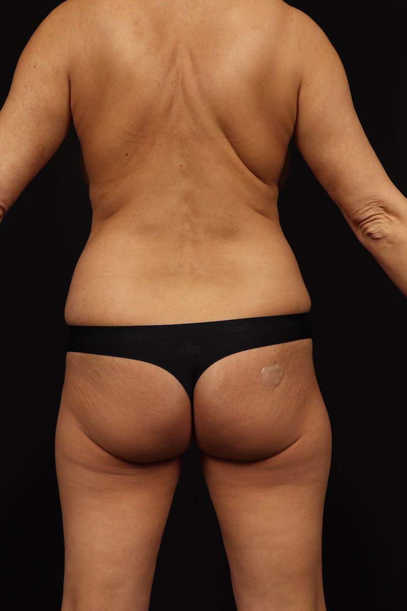 Aesthetic Breast Revision Before & After Gallery - Patient 472421 - Image 11