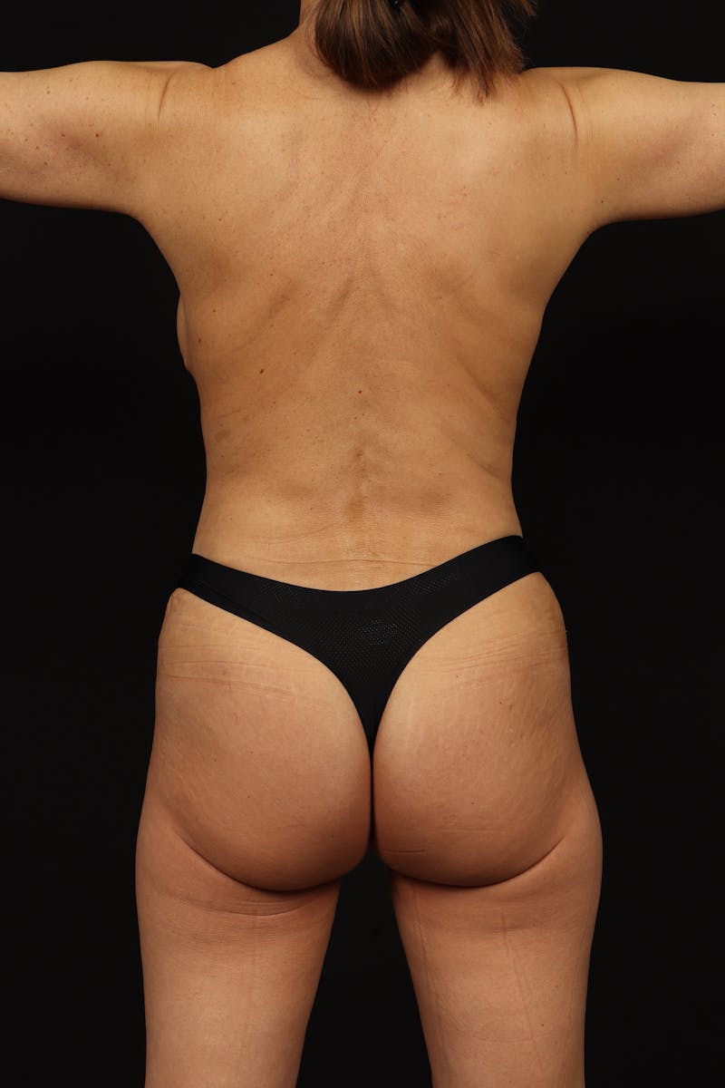 Aesthetic Breast Revision Before & After Gallery - Patient 472421 - Image 12