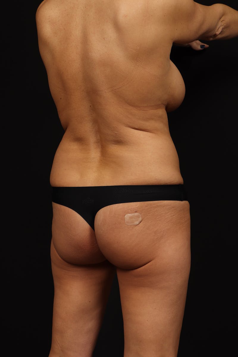 Brazillian Butt Lift Before & After Gallery - Patient 823972 - Image 15