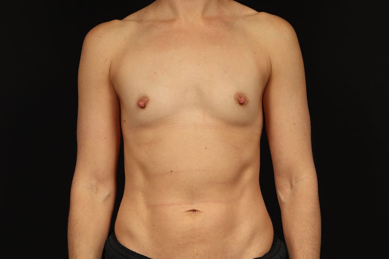 Breast Augmentation Silicone Gel Before & After Gallery - Patient 531770 - Image 1