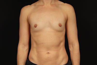 Breast Augmentation Silicone Gel Before & After Gallery - Patient 531770 - Image 1