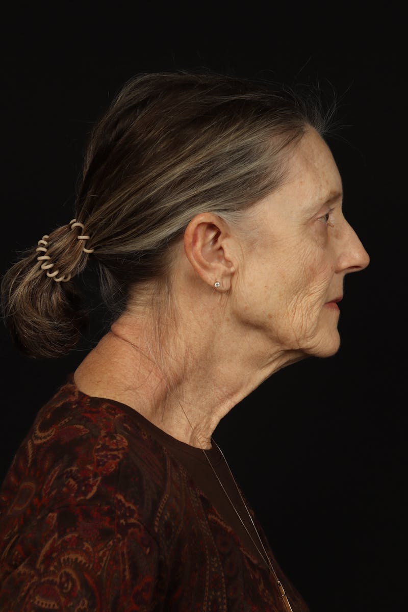 Facelift Before & After Gallery - Patient 366569 - Image 9