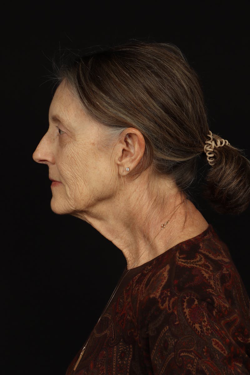 Facelift Before & After Gallery - Patient 366569 - Image 5