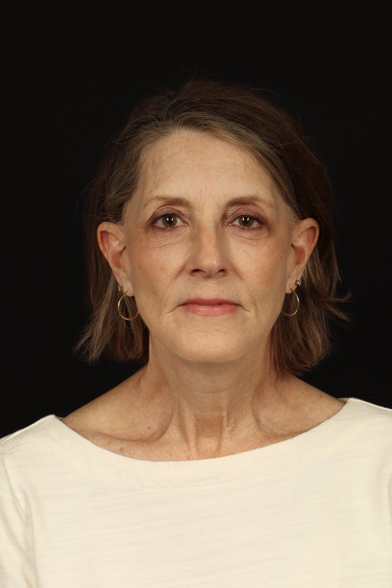 Facelift Before & After Gallery - Patient 366569 - Image 2