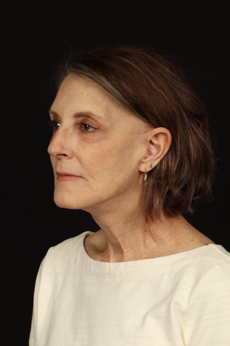 Facelift Before & After Gallery - Patient 366569 - Image 4