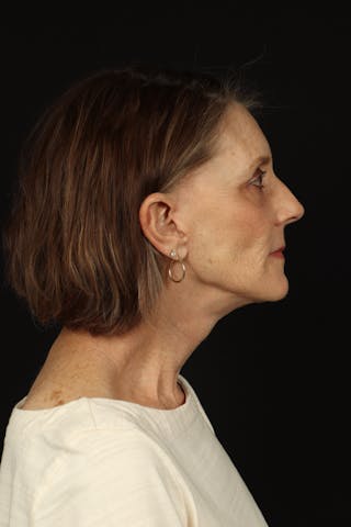 Facelift Before & After Gallery - Patient 366569 - Image 10