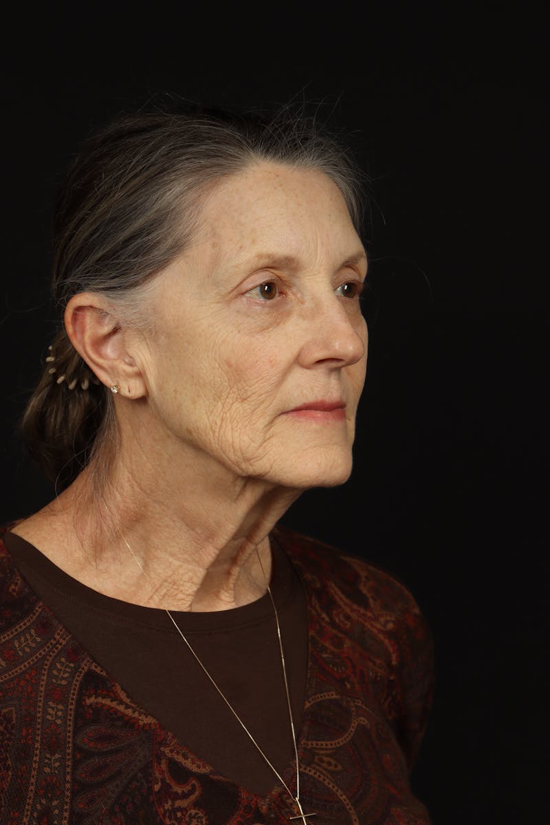 Facelift Before & After Gallery - Patient 366569 - Image 7