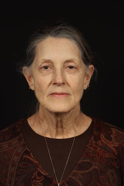 Facelift Before & After Gallery - Patient 366569 - Image 1