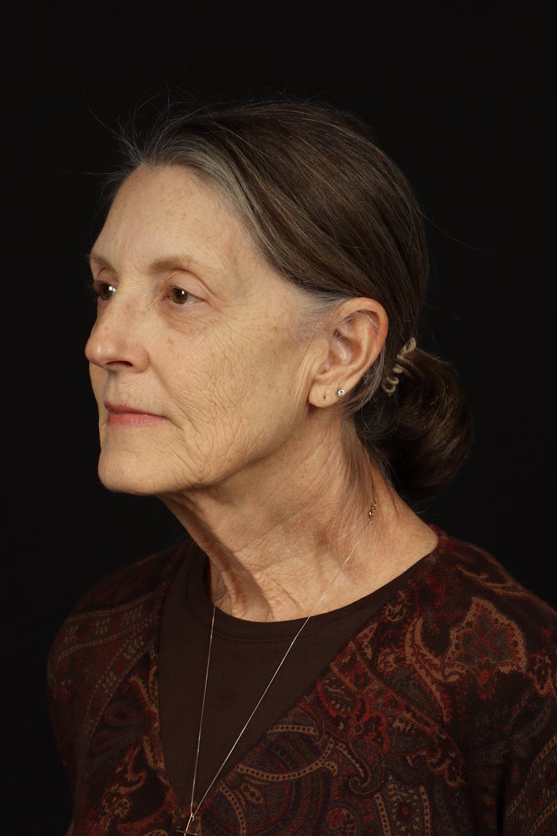 Facelift Before & After Gallery - Patient 366569 - Image 3