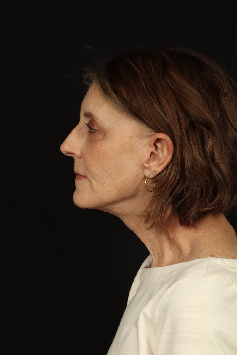 Facelift Before & After Gallery - Patient 366569 - Image 6