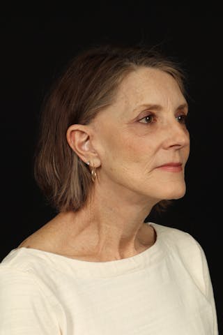 Facelift Before & After Gallery - Patient 366569 - Image 8