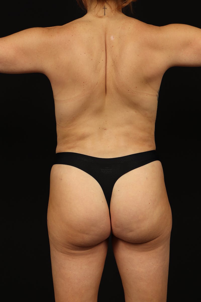 Aesthetic Breast Revision Before & After Gallery - Patient 159903 - Image 10