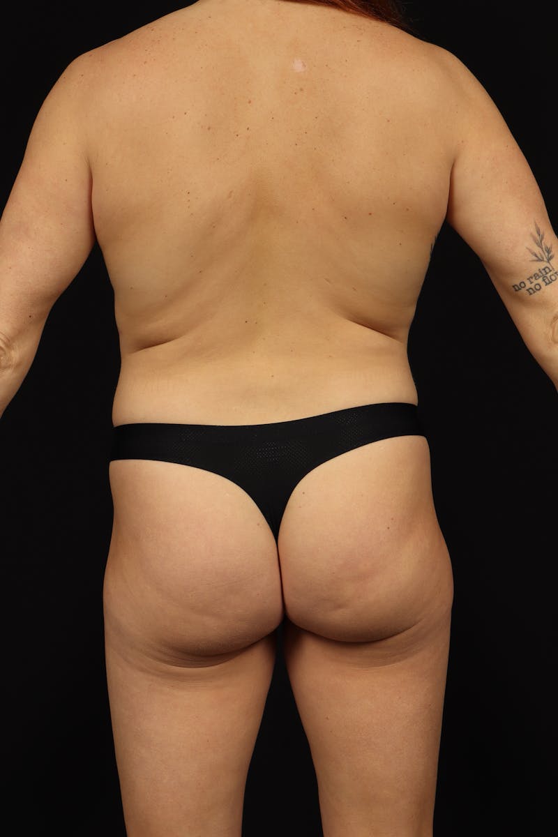 Aesthetic Breast Revision Before & After Gallery - Patient 159903 - Image 9