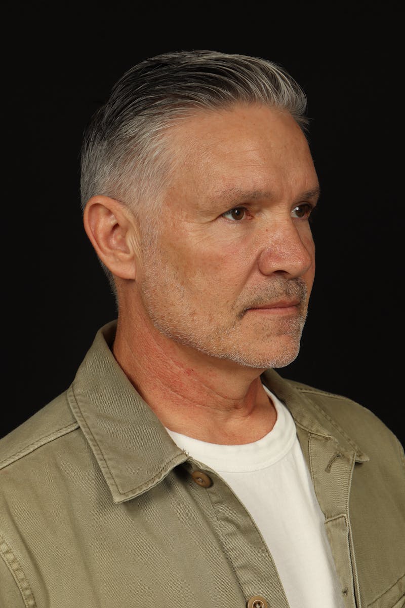 Facelift Before & After Gallery - Patient 380722 - Image 7