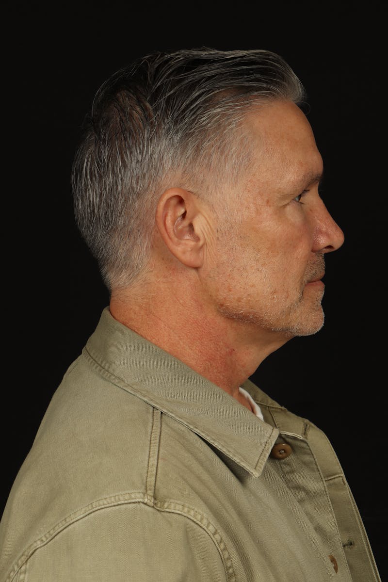 Facelift Before & After Gallery - Patient 380722 - Image 9