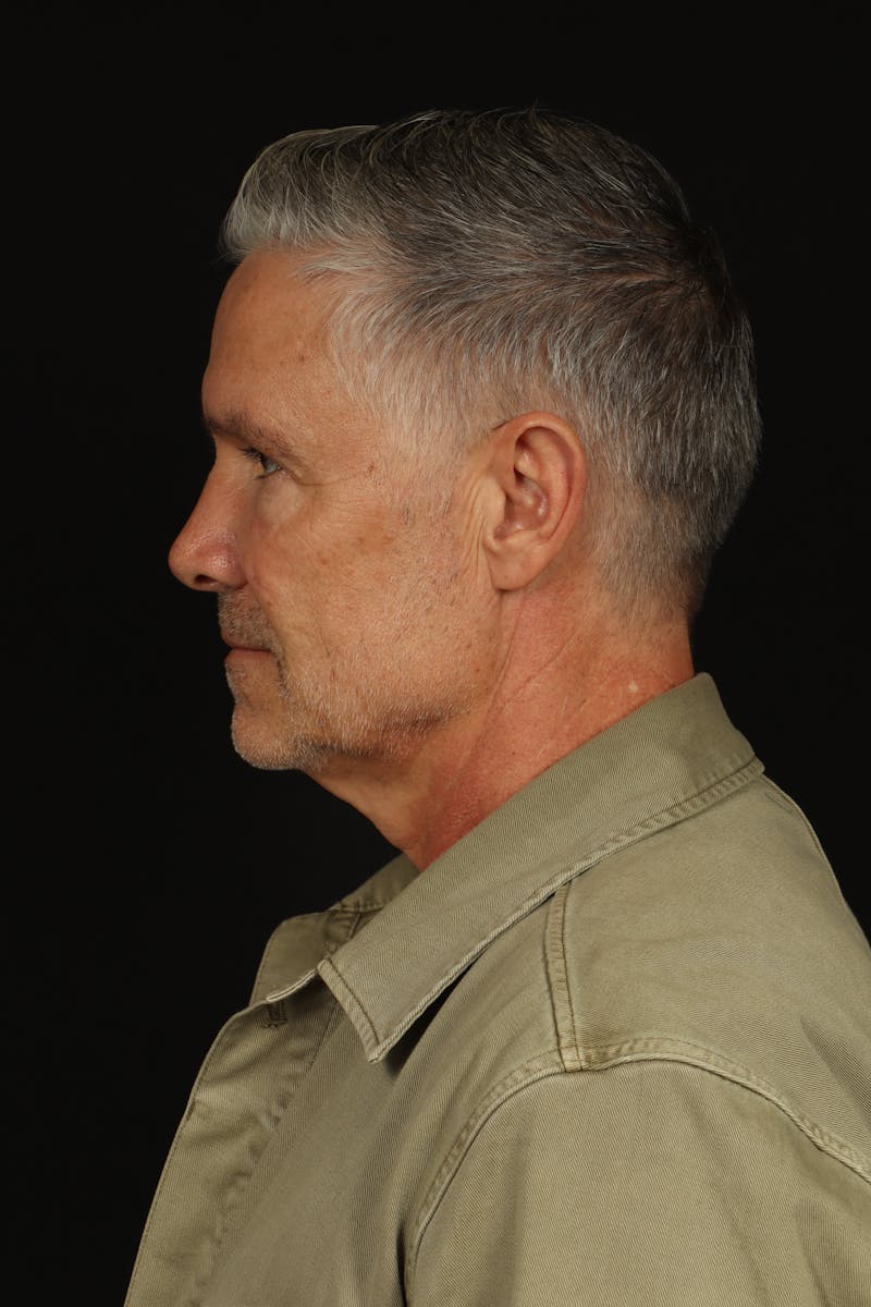 Facelift Before & After Gallery - Patient 380722 - Image 5