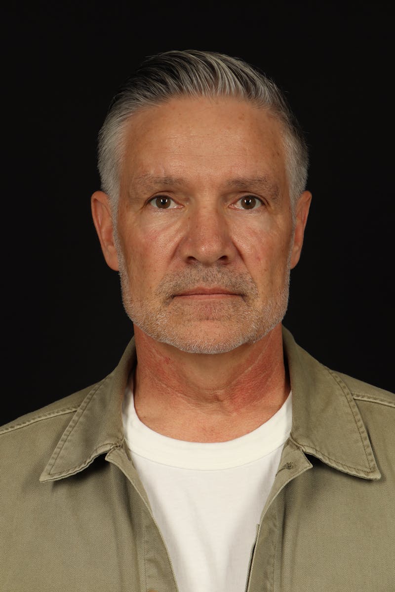 Facelift Before & After Gallery - Patient 380722 - Image 1