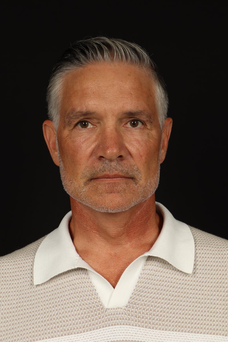 Facelift Before & After Gallery - Patient 380722 - Image 2