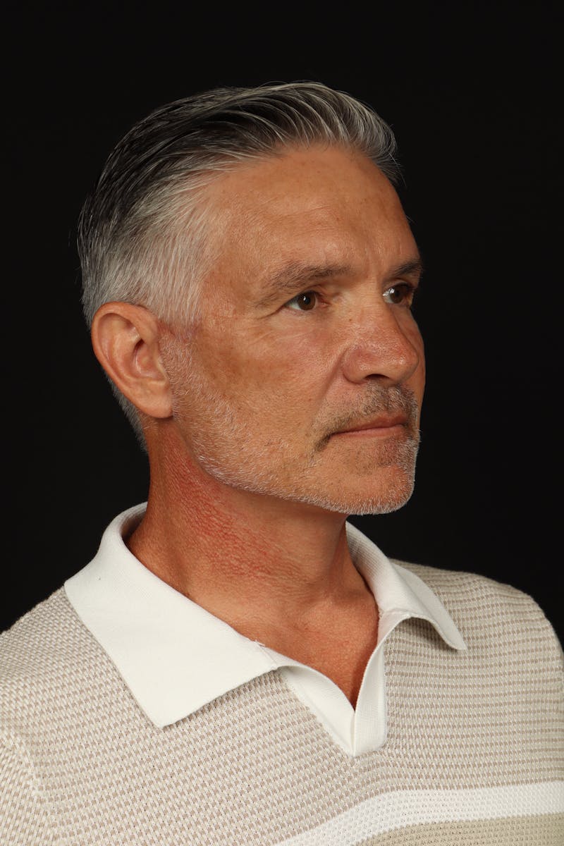 Facelift Before & After Gallery - Patient 380722 - Image 8