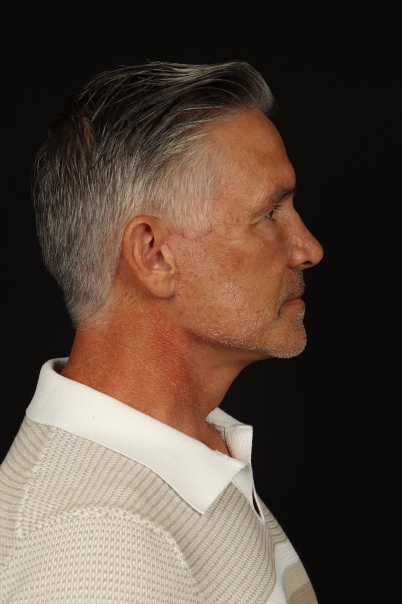Facelift Before & After Gallery - Patient 380722 - Image 10