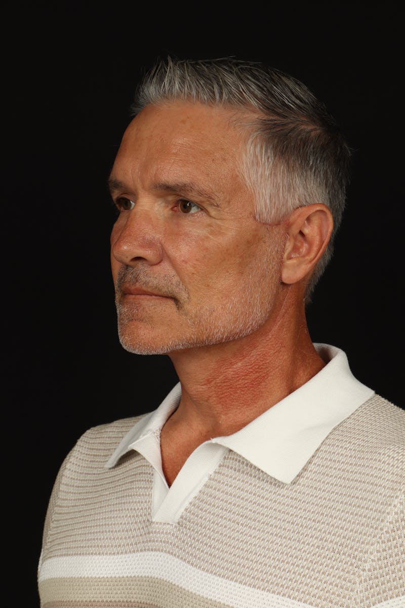 Facelift Before & After Gallery - Patient 380722 - Image 4