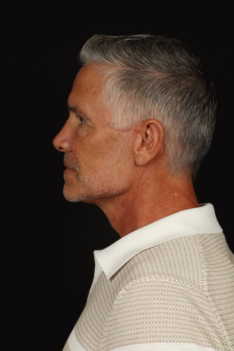 Facelift Before & After Gallery - Patient 380722 - Image 6