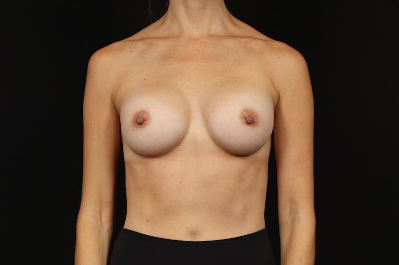 Breast Augmentation Silicone Gel Before & After Gallery - Patient 222727 - Image 2