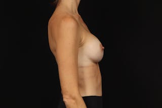 Breast Augmentation Silicone Gel Before & After Gallery - Patient 222727 - Image 10