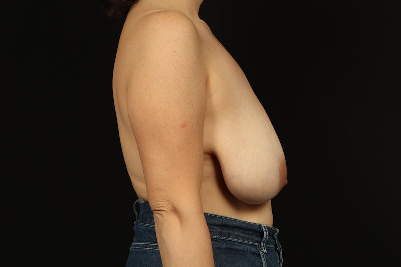 Breast Reduction Before & After Gallery - Patient 389492 - Image 9