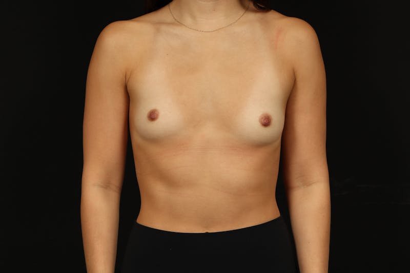 Breast Augmentation Silicone Gel Before & After Gallery - Patient 962305 - Image 1