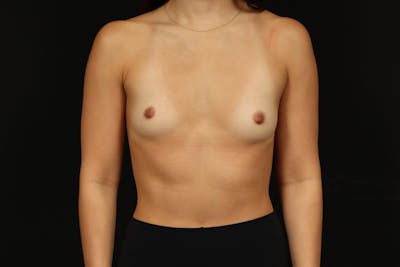 Breast Augmentation Silicone Gel Before & After Gallery - Patient 962305 - Image 1