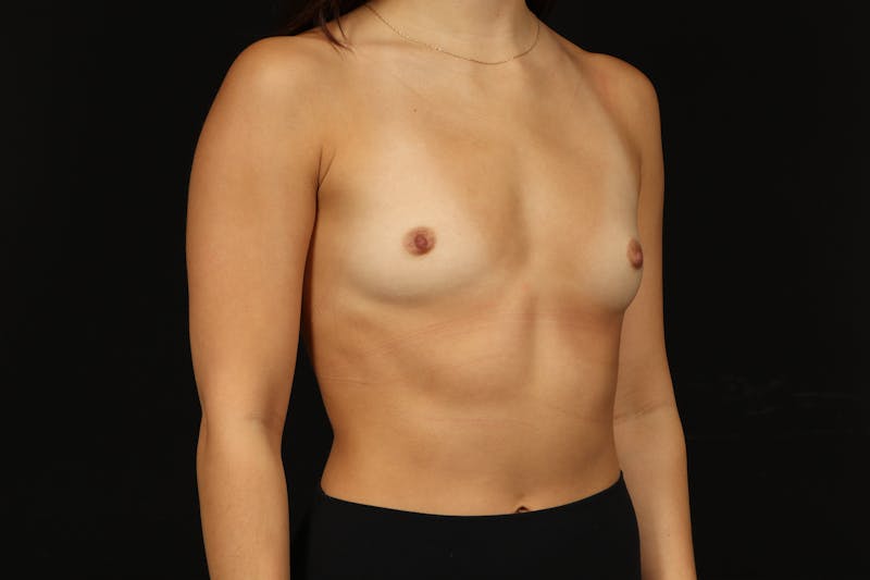 Breast Augmentation Silicone Gel Before & After Gallery - Patient 962305 - Image 7