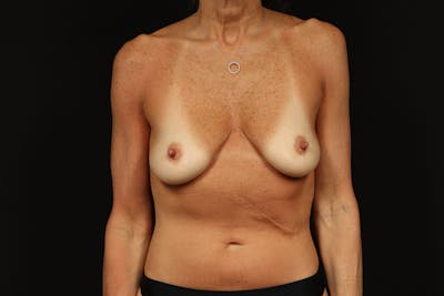Breast Augmentation Mastopexy Before & After Gallery - Patient 194189 - Image 1