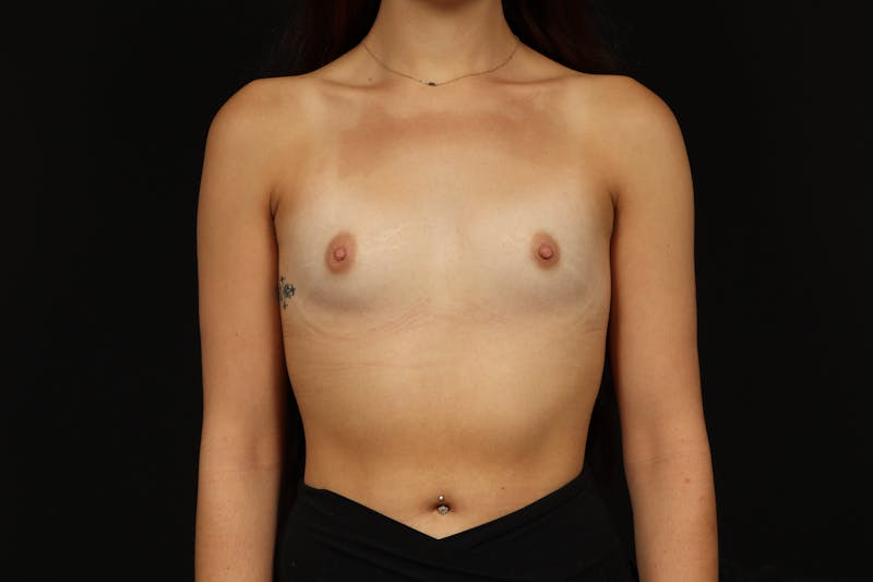 Breast Augmentation Silicone Gel Before & After Gallery - Patient 795718 - Image 1