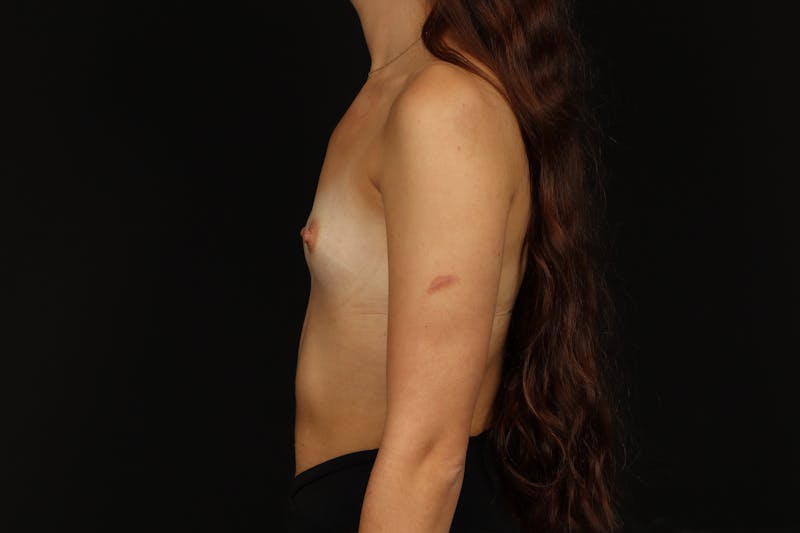 Breast Augmentation Silicone Gel Before & After Gallery - Patient 795718 - Image 5