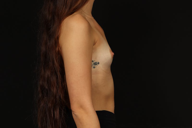 Breast Augmentation Silicone Gel Before & After Gallery - Patient 795718 - Image 9