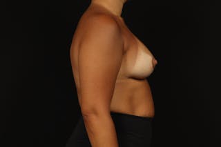 Breast Augmentation Mastopexy Before & After Gallery - Patient 181127 - Image 10
