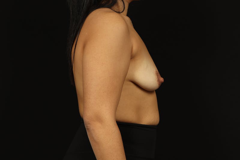 Breast Augmentation Mastopexy Before & After Gallery - Patient 181127 - Image 9