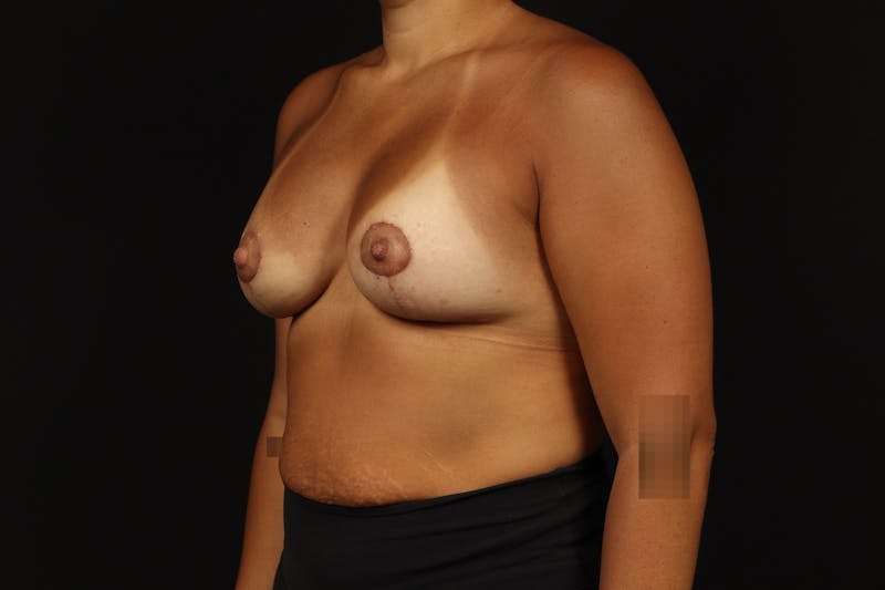 Breast Augmentation Mastopexy Before & After Gallery - Patient 181127 - Image 4